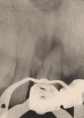 Figure 1: Initial radiograph periapical lesion and broken file in root canal.