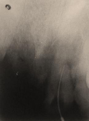 Figure 2: Lateral perforation.