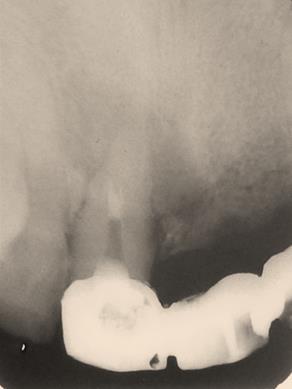 Figure 3: Perforation was sealed with MTA obturation.