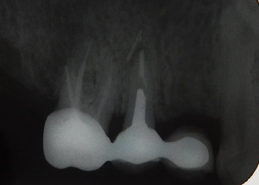 Figure 7: Initial periapical radiograph showed radiolucency related to the apex of 15.