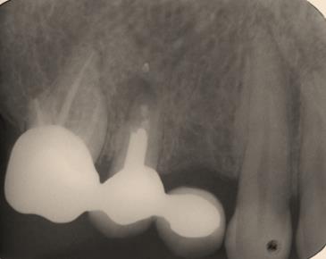 Figure 8: Immediate post surgery radiograph after 9 month post-surgery.