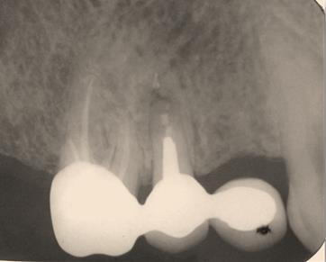 Figure 9: Follow up radiograph Periapical healing observed around Periapical area.