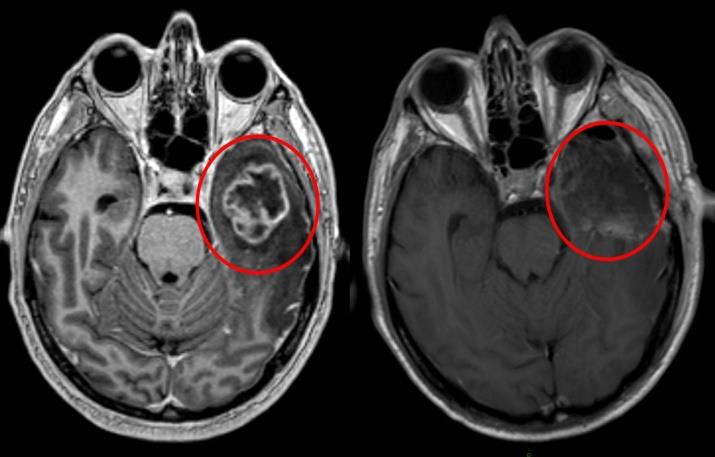 Figure 10: Rheumatic cardiomyopathy.