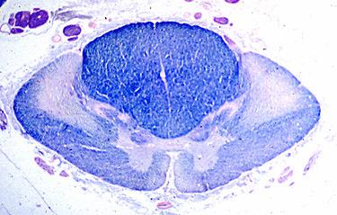 Figure 13: Brain Cancer.