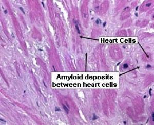 Figure 6: Vessel Atherosclerosis.
