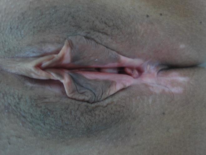 Figure 6: lichen simplex chronicus.