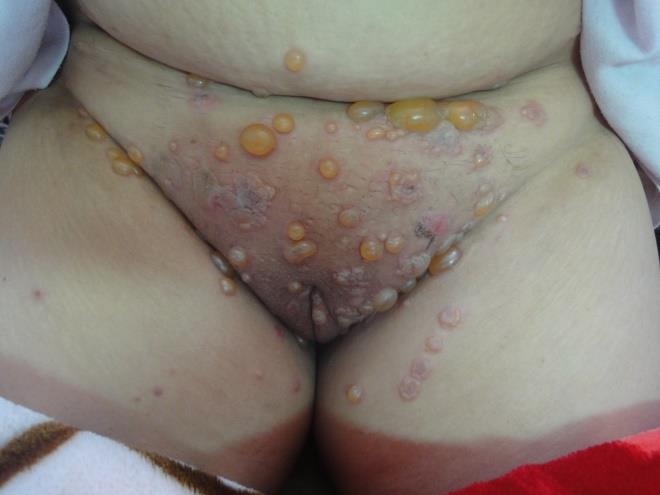 Figure 8: Lichen sclerosus.