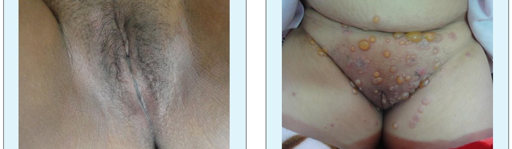 Figure 9: Linear I g A dermatosis.