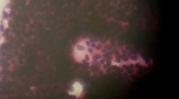 Figure 2: Smear showing endometrial cells with small uniform cells bland chromatin and scanty cytoplasm. (400x, high power)