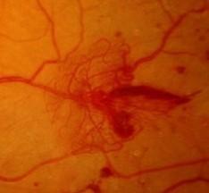 Figure 11: Fluorescein angiogram shows areas of hypo perfusion and capillary dropout.