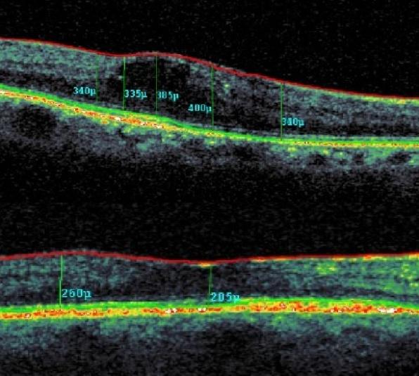 Figure 2: Shows thickening of the macula and cyst formation as a result of diabetic macular edema (above) where (bottom) shows resolution of diabetic macular edema after injecting intravitreal VEGF blockade.