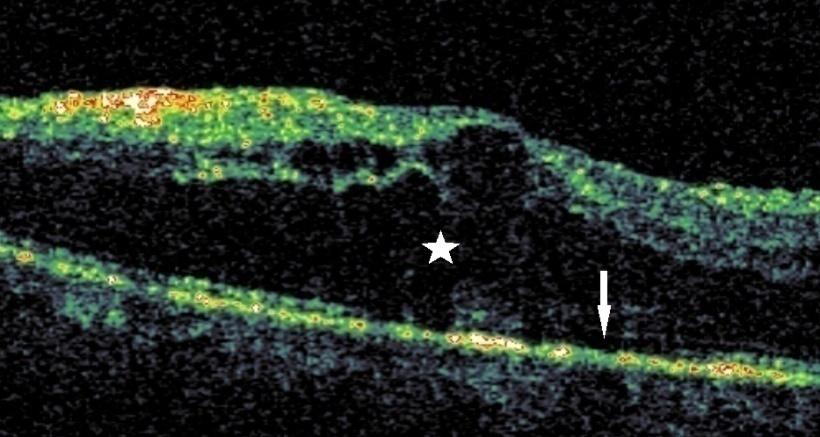 Figure 3: Chronic macular edema showing diffuse leakage and neural tissue damage (star) and loss of photoreceptor loss (arrow).