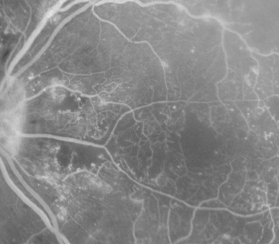 Figure 4: Shows enlarged FAZ and capillary loss and blockage.