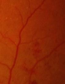 Figure 7: Intra retinal Microaneurisms.