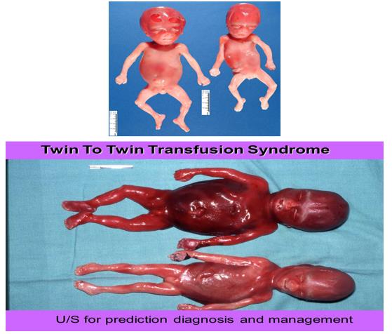 Figure 11: A schematic view of an autosomal recessive hereditary pattern that follows TTT syndrome.