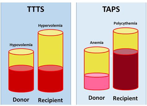 Figure 14: Schematic of the penetration rate (capillary) in normal twins (right) against large blood regression (regimen) in twins with TTT syndrome (left).