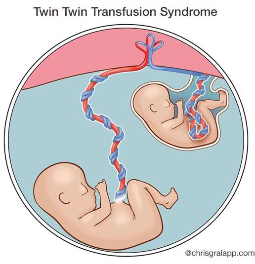 Figure 3: Another schematic of TTT syndrome in human embryos.