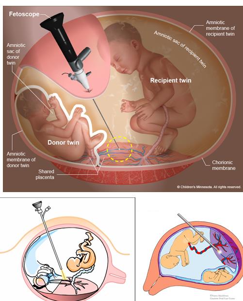 Figure 9: Schematic of placement of twin embryos with TTT syndrome in the mother's womb.