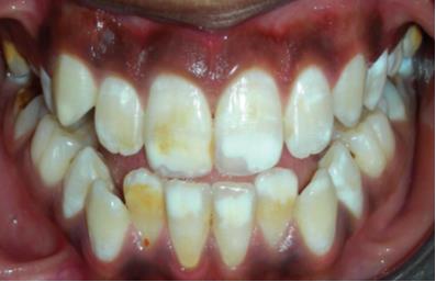 Figure 1: Mild [Demarcated opacities on incisors].