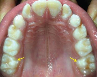 Figure 2: Mild defects [Demarcated opacities on PFMs].