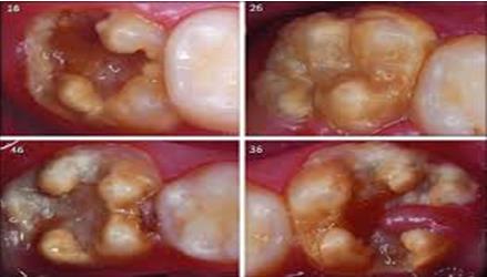Figure 4: Severe defect [Posteruptive enamel breakdown].