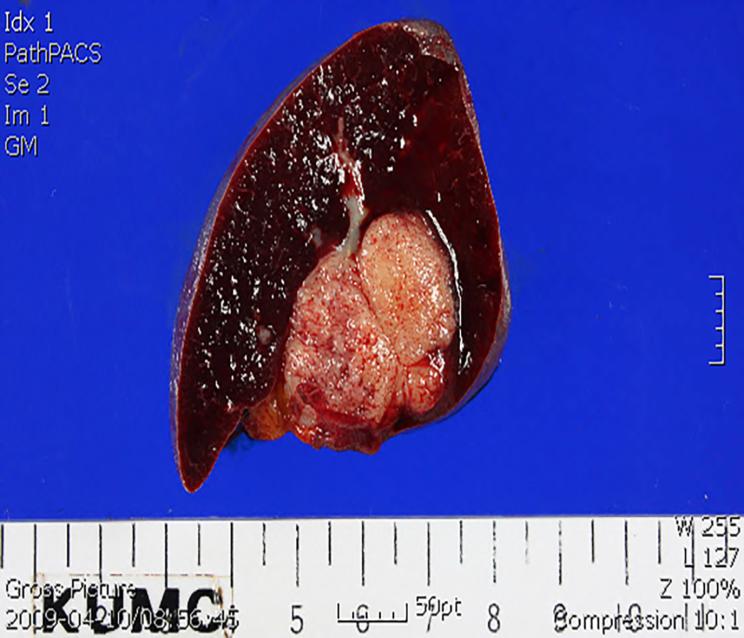 Figure 2: Gross appearance of the spleen specimen after resection (Case 1). Case 2 A 58-year-old woman was admitted to our department due to a solitary splenic mass. Two years prior to her admission, she had undergone a cytoreductive operation that included hysterectomy, bilateral salpingo- oophorectomy, partial omentectomy, appendectomy, and lymph node dissection. Histopathological examination revealed ovarian papillary serous cystadenocarcinoma, stage FIGO IIIc. Following the surgery, she received six cycles of adjuvant chemotherapy with paclitaxel and carboplatin and three cycles of consolidation chemotherapy with the same regimen. Follow-up abdominal computed tomography (CT) showed a newly visible low-attenuating nodule in the spleen (Figure 3), and laparoscopic splenectomy was performed. Macroscopically the spleen was 60 g with a focal fibrotic and nodular surface (Figure 4). Histological results revealed a metastatic adenocarcinoma, primary in the ovary. She was discharged on postoperative day 8 without any postoperative complications. She received adjuvant systemic chemotherapy with paclitaxel and carboplatin and was disease free for 24 months.
