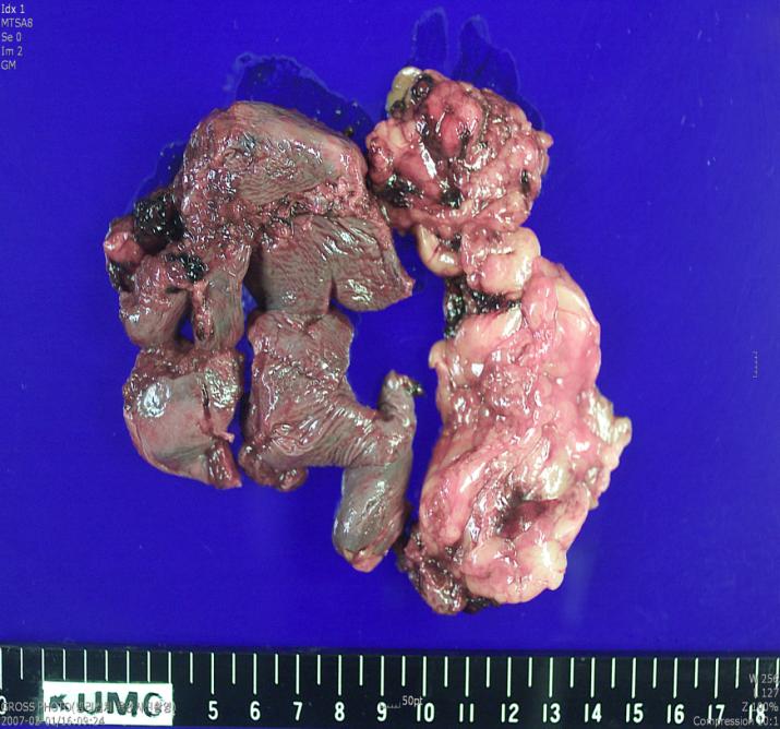 Figure 4: Gross appearance of the spleen specimen after resection (Case 2).