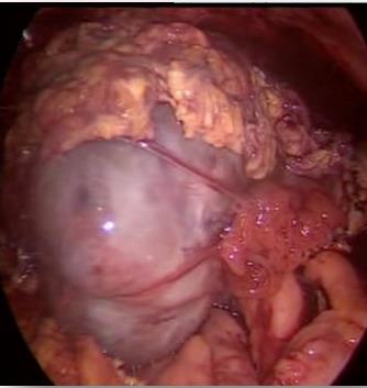 Figure 6: Granulocytic ovarian sarcoma, laparoscopic view.