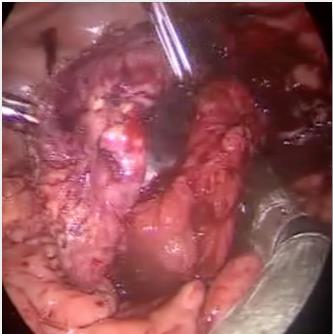 Figure 7: Laparoscopic tumor excision with a stapler.