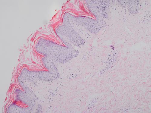 Figure 2: Epidermis with marked papillomatous and hyperkeratosis signs HEx100.