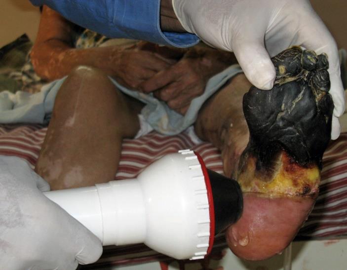 Figure 1: 90-year-old lady being treated with CellSonic VIPP.