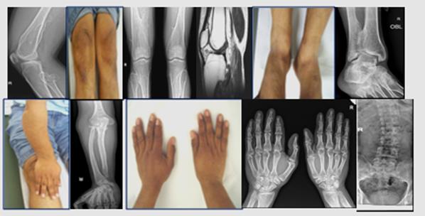 Figure 1: Pictorial and radiological (X-ray and MRI images) of the patient showing the various affected skeletal sites along with the spinal scoliosis.