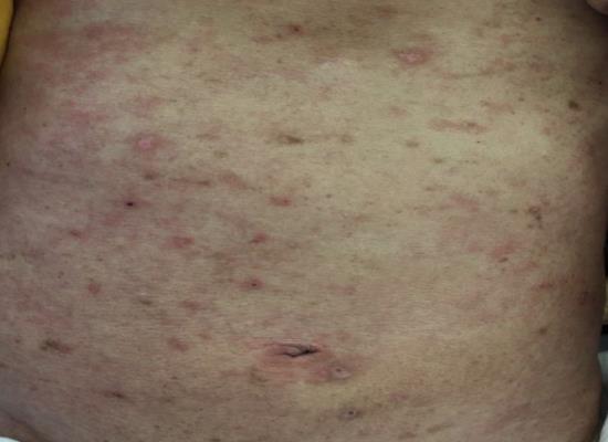 Figure 1: Scratch lesions.