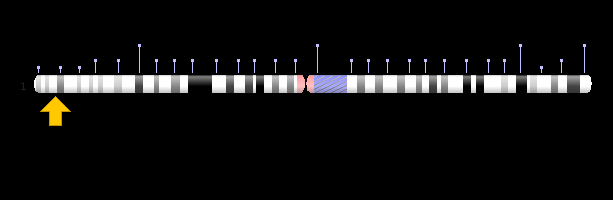 Figure 2: The picture of a newborn with an anencephaly syndrome associated with brain disorders and facial features.