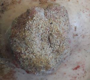 Figure 1: Sister mary joseph’s nodule.