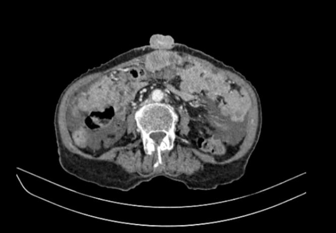 Figure 2: Abdominal CT showing hepatic metastases, peritoneal carcinomatosis with infiltration of the rectus muscle.
