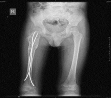 Figure 2: X-ray showing the right femur with intramedullary rod.