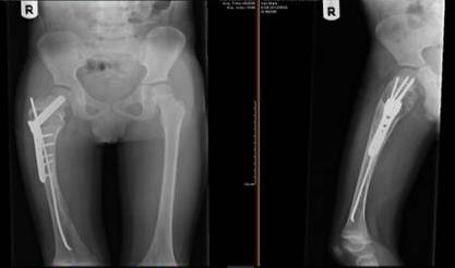 Figure 3: X-ray of the right femur with a slab and nail.