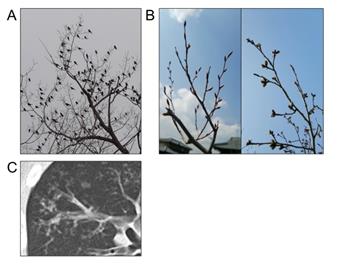 Figure 1: (A) “Bird-on-tree”. (B) The bud of the tree. (C) “Bud-in-tree” appearance.