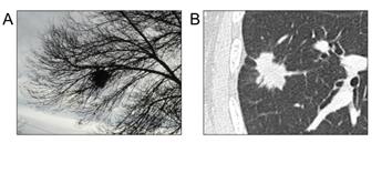 Figure 2: (A) A “NESToma”. (B) An adenocarcinoma.