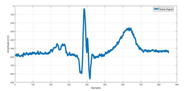Figure 4: R-wave detection based on wavelets analysis: a) Anterioseptal V1 lead (Solid blue line), R-wave peak (red triangle); b) Anterior V4 lead (Solid blue line), R-wave peak (red triangle).