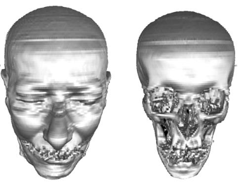 Figure 12: Risk neurosurgical access. (a) Geometric representation. (b) Graphical representation It is therefore necessary to include personal volumetric map for the invasiveness track, which would take into account the physiological significance details of