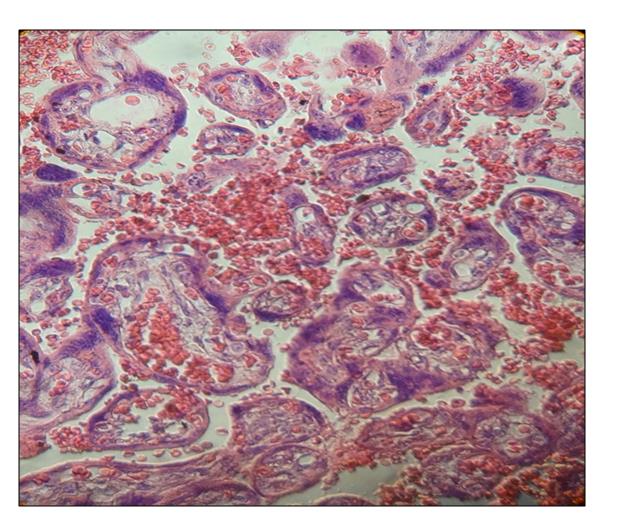 Figure 1: Thinner throphoblast is noted and accumulations of this tissue appears in intervillous space.400x.H&E.