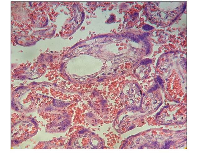 Figure 2: A vessel with interrupted endothelium is observed.400x.H&E.