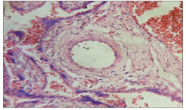 Figure 3: Stem villi shows in stromal region edematous muscular layer of vessel.400x.H&E.