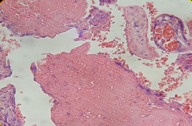 Figure 7: Destroyed villi can be seen.400x.H&E.