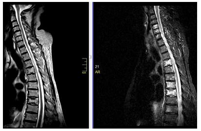 Figure 12: T1weighted (upper row) and T2 weighted (lower row) axial images of spine performed with the the 0.35 Tesla Magnetom-C (SIEMENS) machine, which showing metastatic lesion.