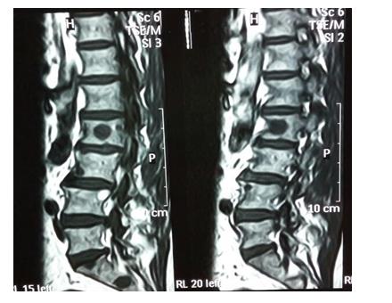 Figure 7: T2 weighted sagittal images performed with the 1.5 Tesla machine which showing only disc bulges and single lesion at L2V, but not clear.