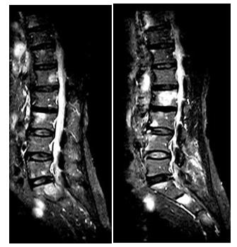 Figure 8: T1 weighted sagittal images performed with 0.35 Tesla Magnetom-C (SIEMENS) machine which showing metastatic lesion at multiple levels of lumbosacral spine.
