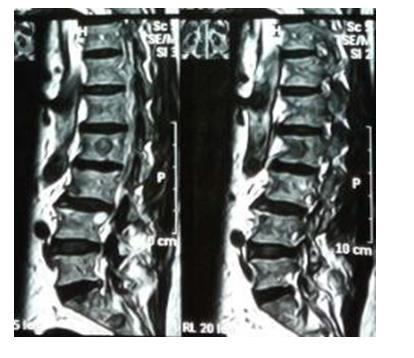 Figure 9: (T2 weighted and STIR Sagittal images performed with the 0.35 Tesla Magnetom-C (SIEMENS) MRI machine which showing hyper intense signals are metastatic lesions at multiple levels of vertebrae of lumbosacral spine.